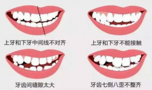 4级冷作钛 种植牙（四级冷作钛和四级纯钛）(图1)